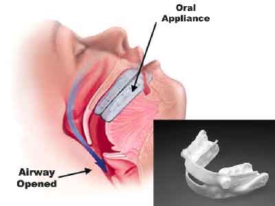 Oral appliance for sleep apnea